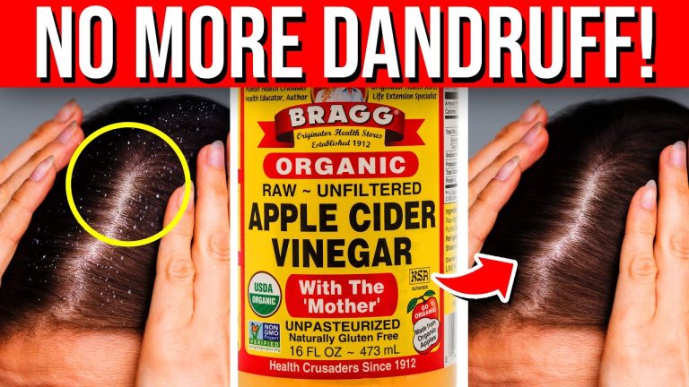 8 NATURAL Ways You Can DESTROY Dandruff Fast
